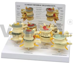 4-Stage Vertebrae